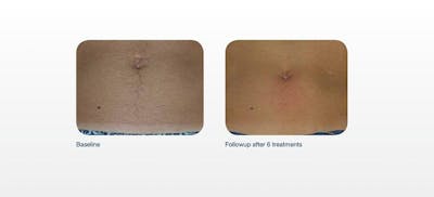 Hair Removal Before & After Gallery - Patient 41897340 - Image 1