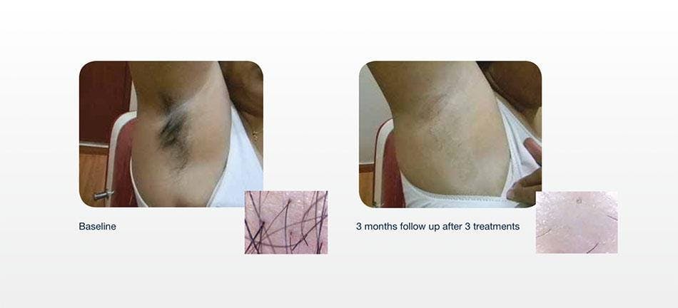 Hair Removal Before & After Gallery - Patient 41897341 - Image 1