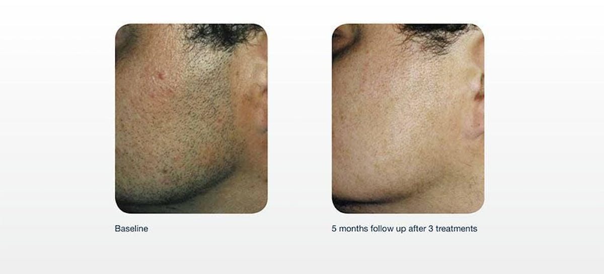 Hair Removal Before & After Gallery - Patient 41897342 - Image 1