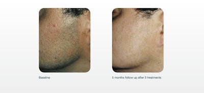 Hair Removal Before & After Gallery - Patient 41897342 - Image 1