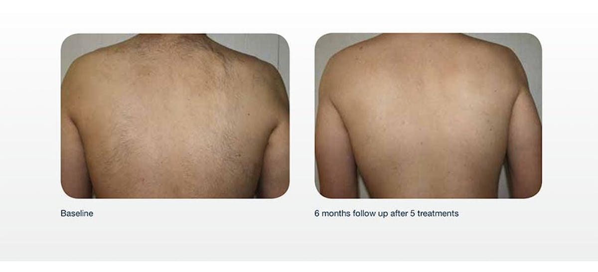 Hair Removal Before & After Gallery - Patient 41897344 - Image 1