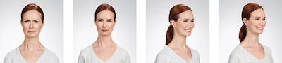 Botox/Xeomin Before & After Gallery - Patient 41897363 - Image 1