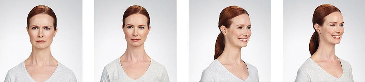 Botox/Xeomin Before & After Gallery - Patient 41897363 - Image 1