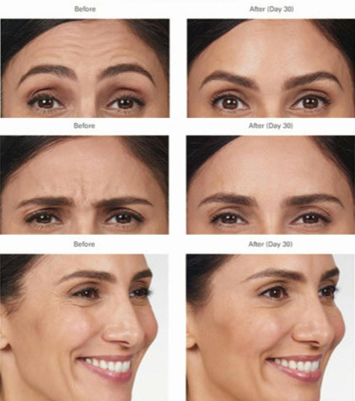 Botox/Xeomin Before & After Gallery - Patient 41897364 - Image 1