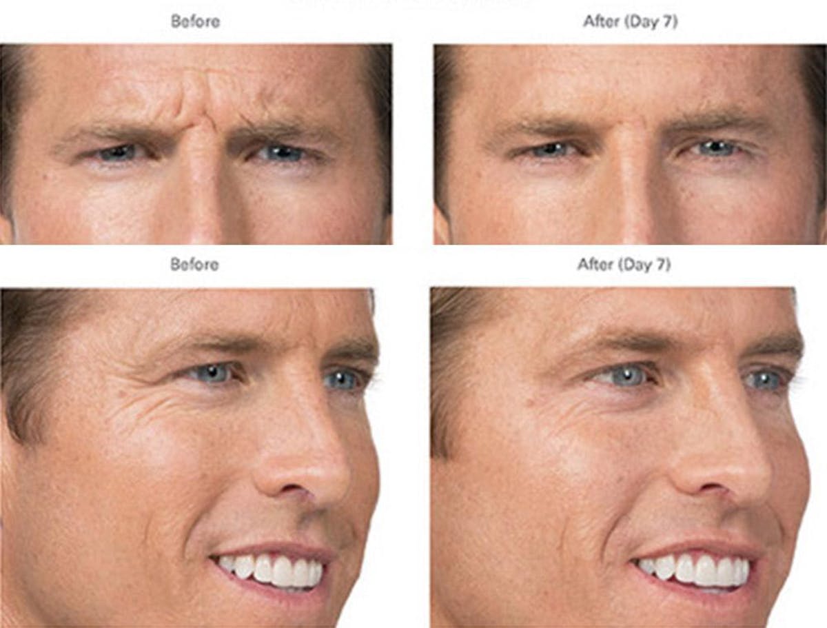 Botox/Xeomin Before & After Gallery - Patient 41897365 - Image 1