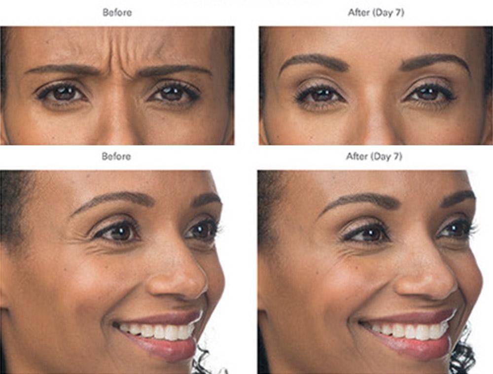 Botox/Xeomin Before & After Gallery - Patient 41897366 - Image 1