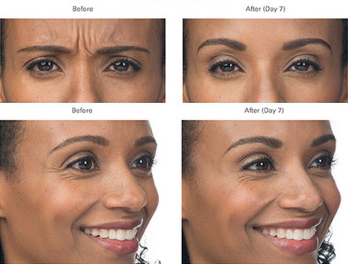 Botox/Xeomin Before & After Gallery - Patient 41897366 - Image 1