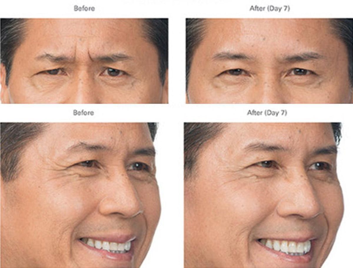 Botox/Xeomin Before & After Gallery - Patient 41897367 - Image 1