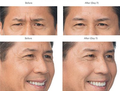 Botox/Xeomin Before & After Gallery - Patient 41897367 - Image 1