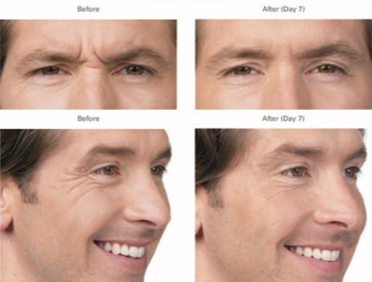 Botox/Xeomin Before & After Gallery - Patient 41897368 - Image 1