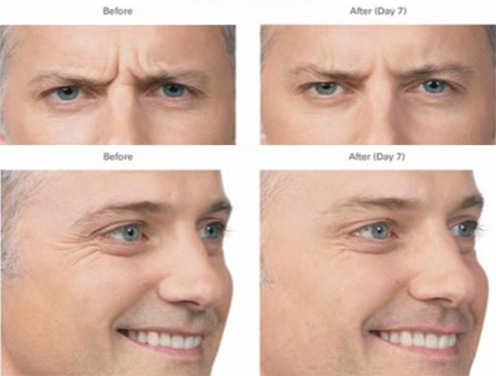 Botox/Xeomin Before & After Gallery - Patient 41897369 - Image 1