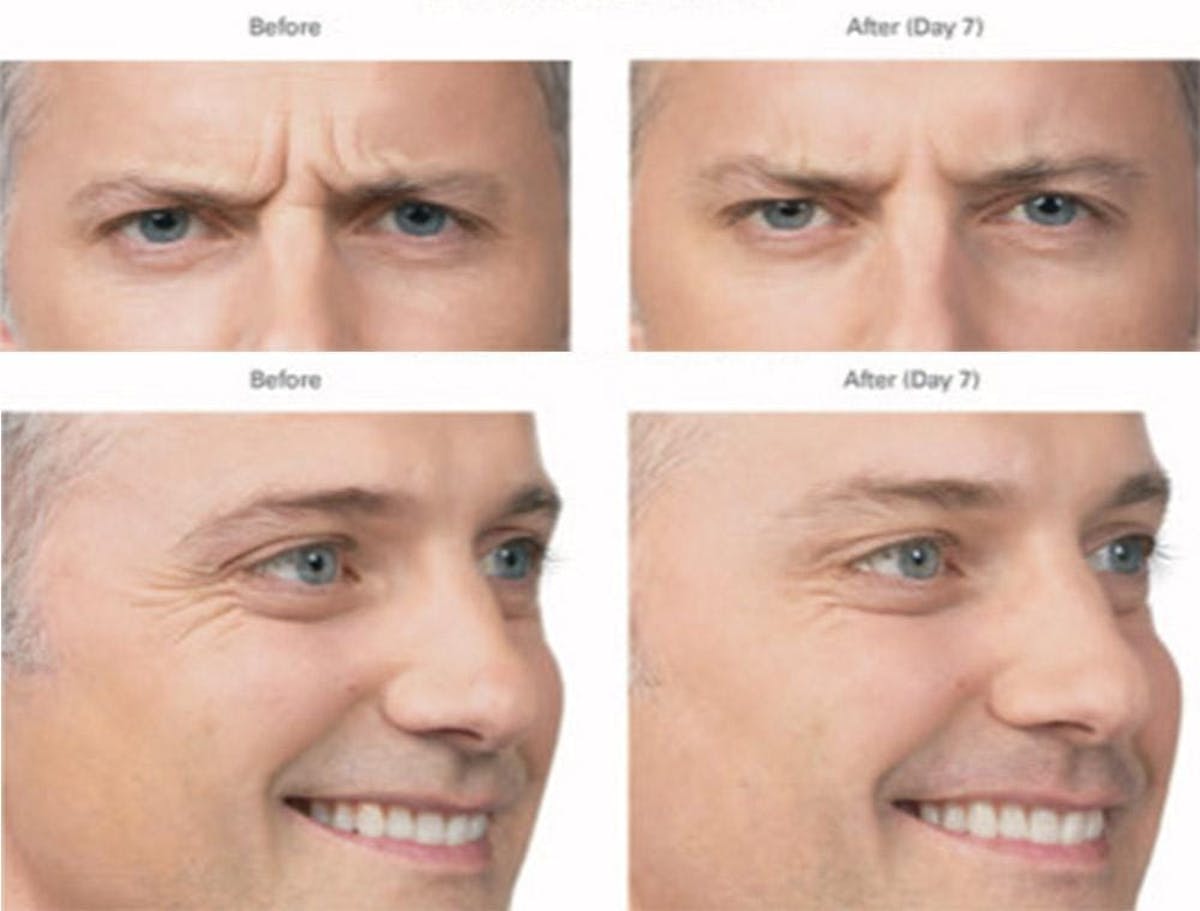 Botox/Xeomin Before & After Gallery - Patient 41897369 - Image 1