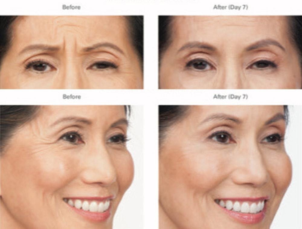 Botox/Xeomin Before & After Gallery - Patient 41897370 - Image 1