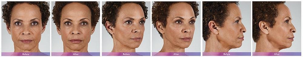 Fillers Before & After Gallery - Patient 41897375 - Image 1