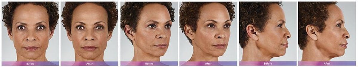 Fillers Before & After Gallery - Patient 41897375 - Image 1