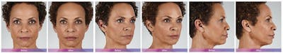Fillers Before & After Gallery - Patient 41897375 - Image 1