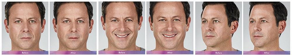 Fillers Before & After Gallery - Patient 41897376 - Image 1