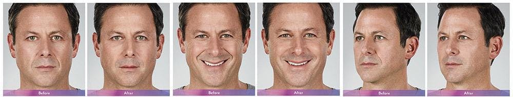 Fillers Before & After Gallery - Patient 41897376 - Image 1
