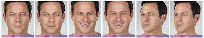 Fillers Before & After Gallery - Patient 41897376 - Image 1