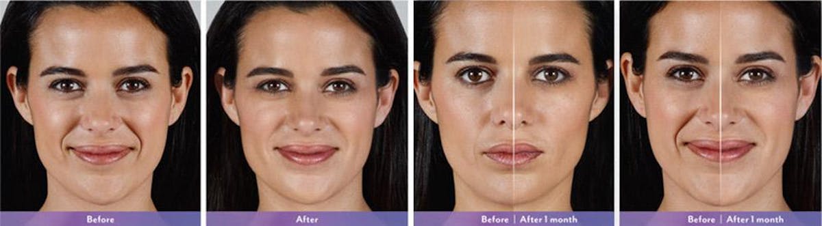 Fillers Before & After Gallery - Patient 41897377 - Image 1