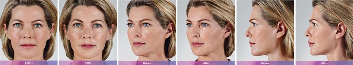 Fillers Before & After Gallery - Patient 41897378 - Image 1
