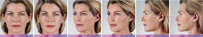 Fillers Before & After Gallery - Patient 41897378 - Image 1