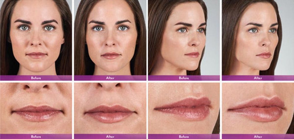 Fillers Before & After Gallery - Patient 41897379 - Image 1