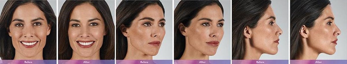 Fillers Before & After Gallery - Patient 41897380 - Image 1