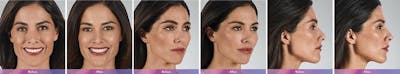 Fillers Before & After Gallery - Patient 41897380 - Image 1