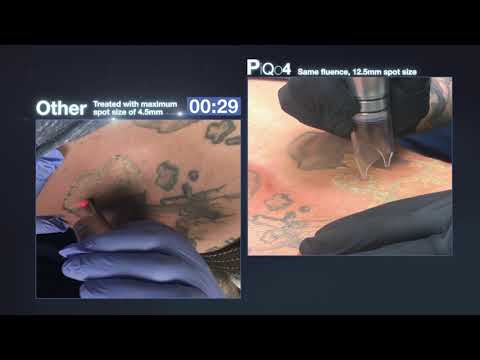 Tattoo removal