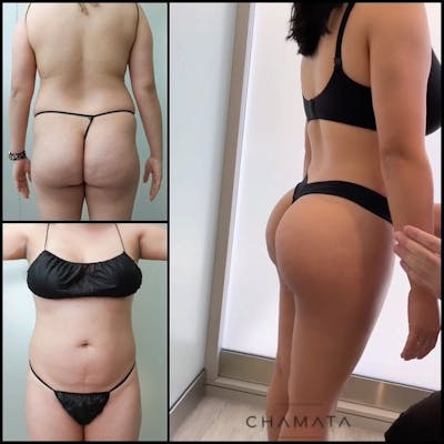 Reels Gallery Before & After Gallery - Patient 104029339 - Image 1