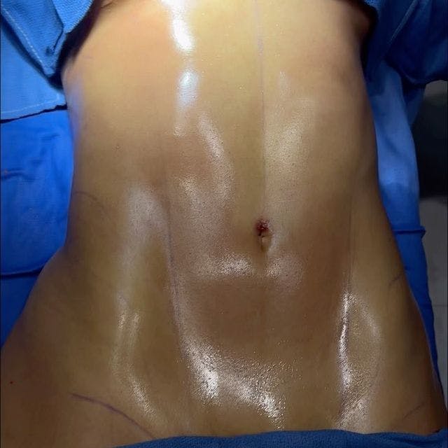 before and after abdominal etching