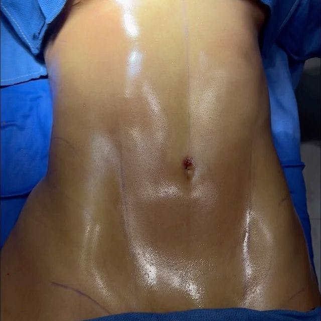 Abdominal Etching in Houston, TX