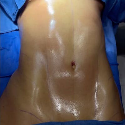 Reels Gallery Before & After Gallery - Patient 104029343 - Image 1