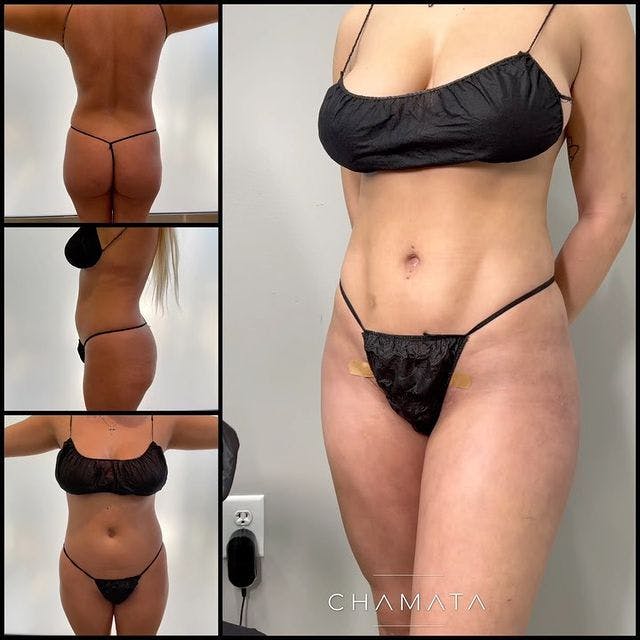 Reels Gallery - Archive of instagram images etc Before & After Gallery - Patient 104029344 - Image 1