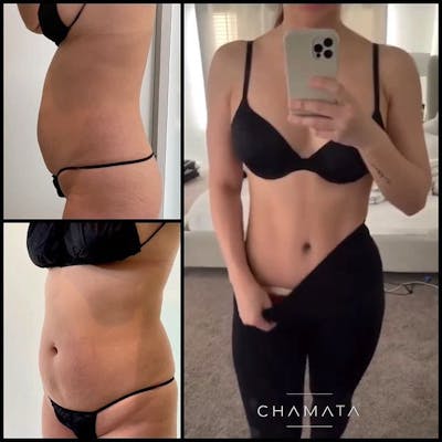 Reels Gallery Before & After Gallery - Patient 104029346 - Image 1