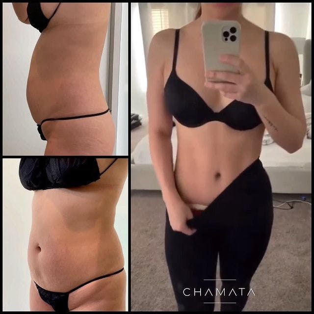 Reels Gallery - Archive of instagram images etc Before & After Gallery - Patient 104029346 - Image 1