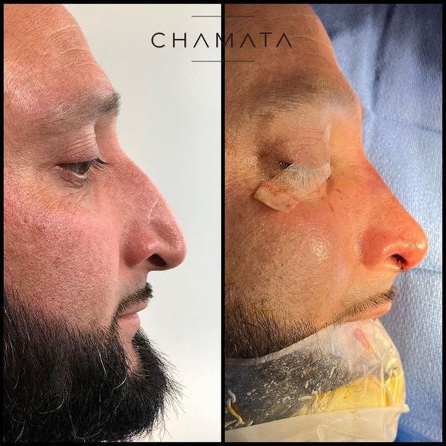 rhinoplasty before and after