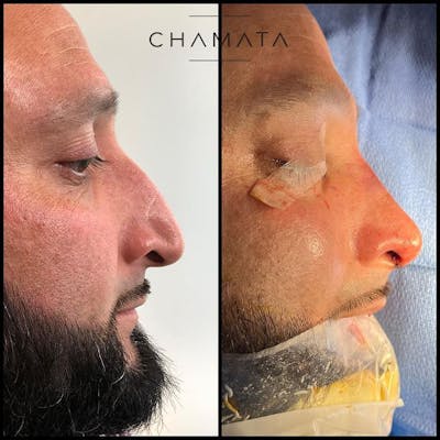 Reels Gallery Before & After Gallery - Patient 121441238 - Image 1