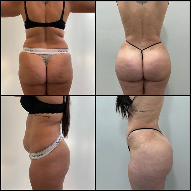 Reels Gallery - Archive of instagram images etc Before & After Gallery - Patient 121441702 - Image 1