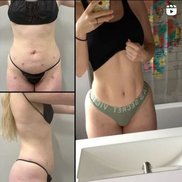 Ab etching before and after