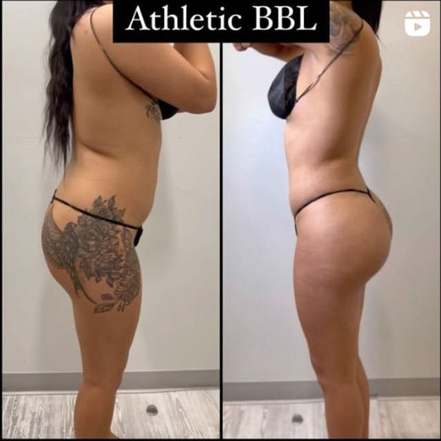 Reels Gallery - Archive of instagram images etc Before & After Gallery - Patient 122204700 - Image 1