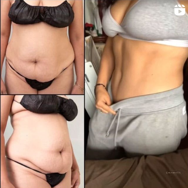 Reels Gallery - Archive of instagram images etc Before & After Gallery - Patient 122204715 - Image 1