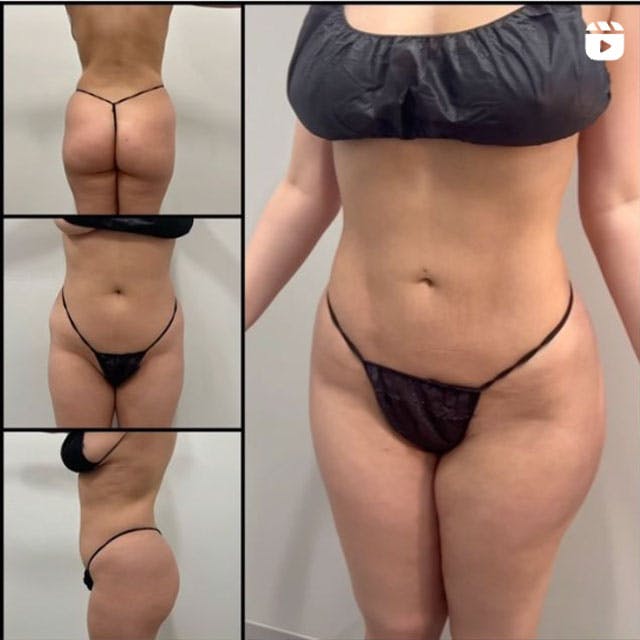 Reels Gallery - Archive of instagram images etc Before & After Gallery - Patient 122204740 - Image 1