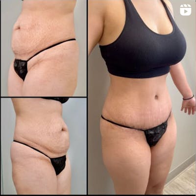 Reels Gallery Before & After Gallery - Patient 122204770 - Image 1