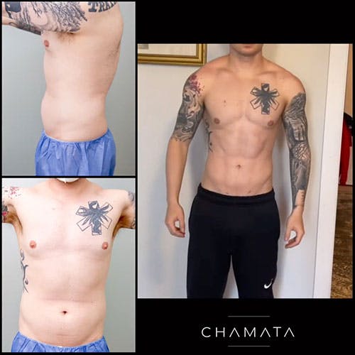 before and after gynecomastia in houston