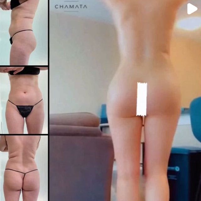 Reels Gallery - Archive of instagram images etc Before & After Gallery - Patient 122705829 - Image 1