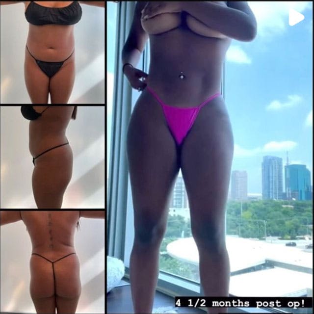 Reels Gallery - Archive of instagram images etc Before & After Gallery - Patient 122705842 - Image 1