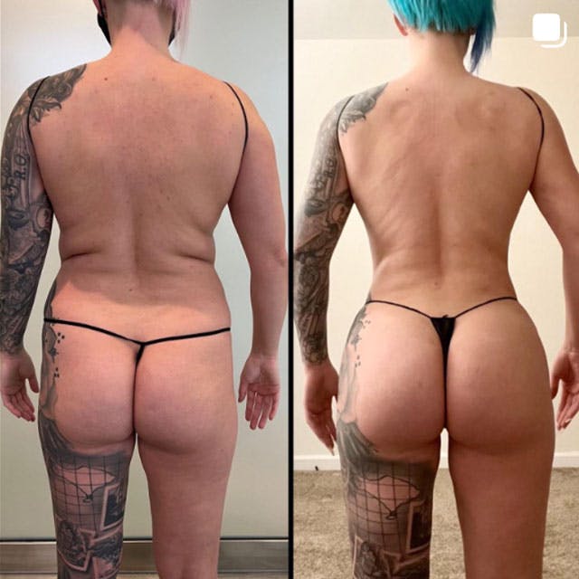 Reels Gallery - Archive of instagram images etc Before & After Gallery - Patient 122707088 - Image 1