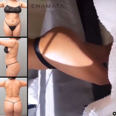 Reels Gallery Before & After Gallery - Patient 123839490 - Image 1